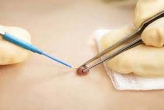 radiofrequency-mole-removal